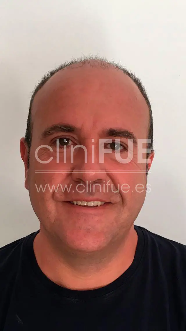 Cristobal 44 Almeria 1 mes Trasplante capilar Turquia cliniFUE