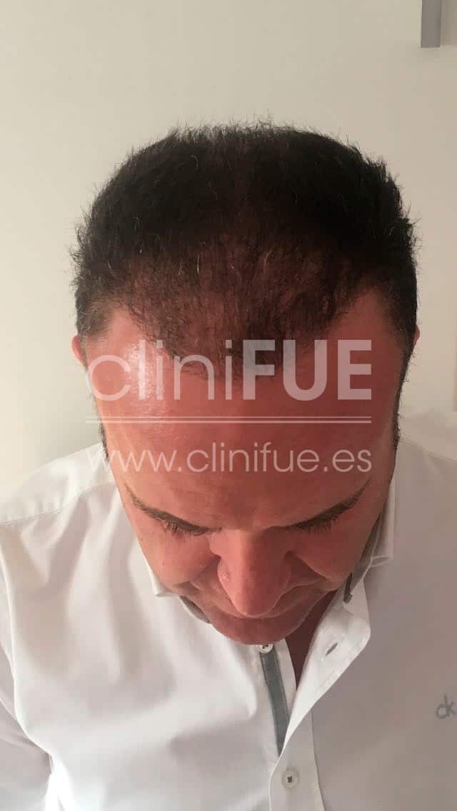 Cristobal 44 Almeria 6 meses Trasplante capilar Turquia cliniFUE