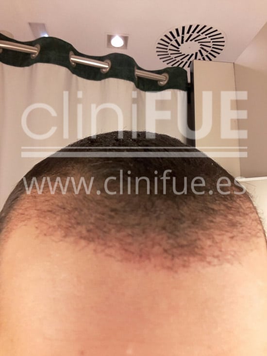 Alan 28 años Madrid trasplante capilar turquia 1 mes