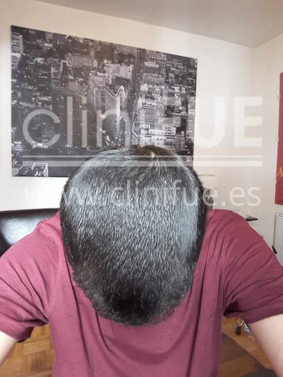 Alan 28 años Madrid trasplante capilar turquia 14 meses