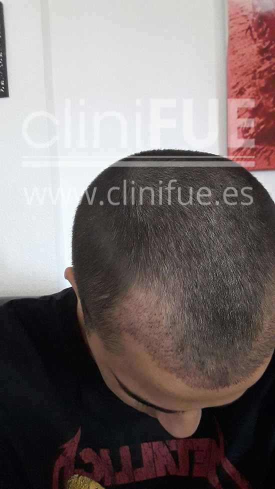 Alan 28 años Madrid trasplante capilar turquia 15 dias
