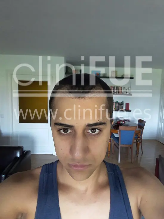 Alan 28 años Madrid trasplante capilar turquia 3 meses