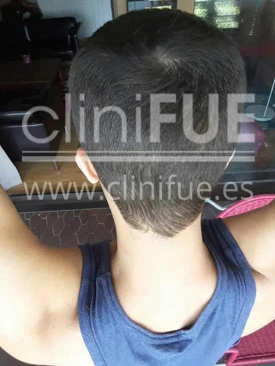 Alan 28 años Madrid trasplante capilar turquia 3 meses