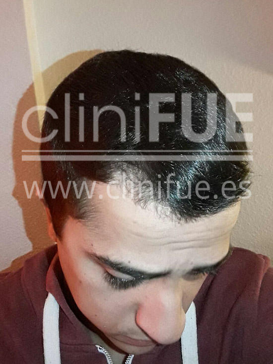 Alan 28 años Madrid trasplante capilar turquia Antes