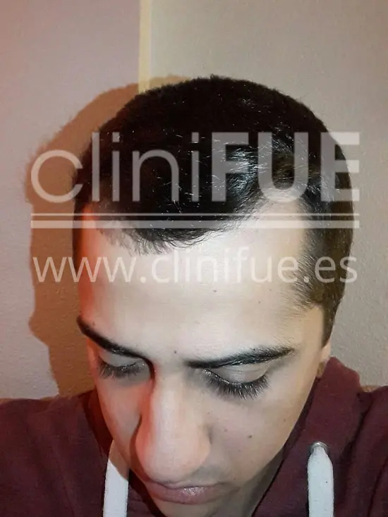 Alan 28 años Madrid trasplante capilar turquia Antes