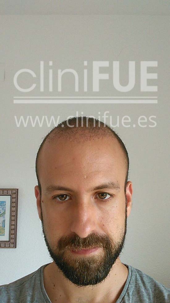 Alberto 31 años Madrid trasplante capilar turquia 1 mes