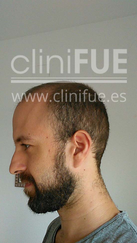 Alberto 31 años Madrid trasplante capilar turquia 1 mes