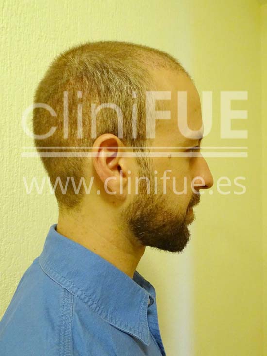 Alberto 31 años Madrid trasplante capilar turquia 15 dias