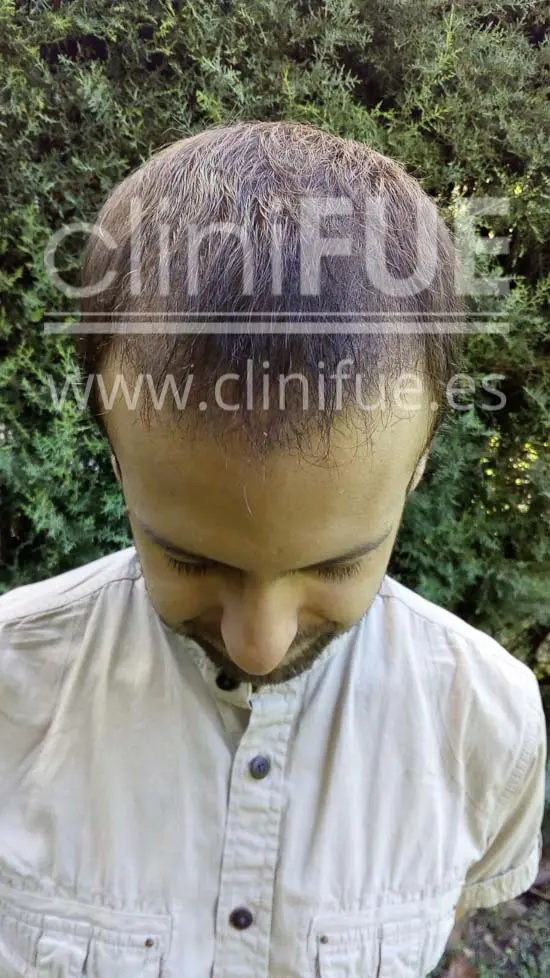 Alberto 31 años Madrid trasplante capilar turquia 3 meses