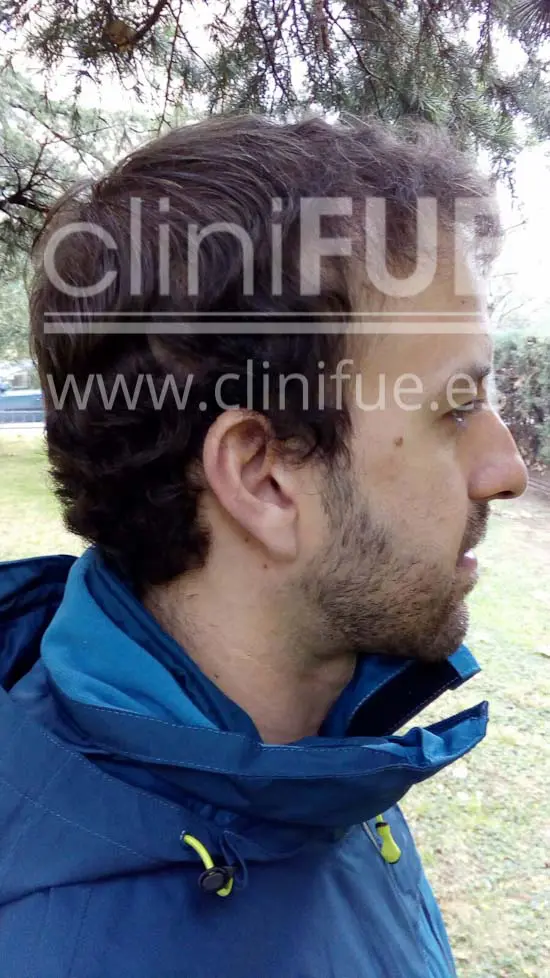 Alberto 31 años Madrid trasplante capilar turquia 6 meses