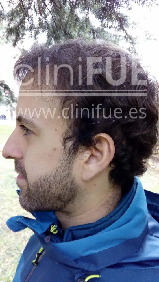 Alberto 31 años Madrid trasplante capilar turquia 6 meses