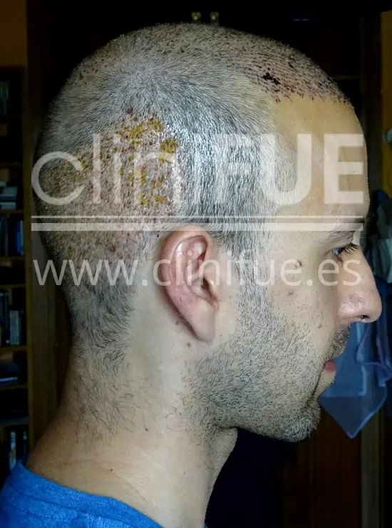 Alberto 31 años Madrid trasplante capilar turquia 7 dias
