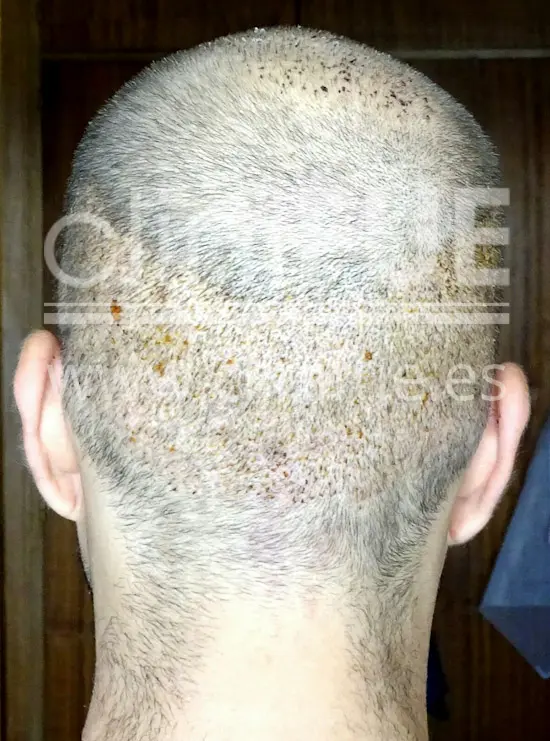 Alberto 31 años Madrid trasplante capilar turquia 7 dias