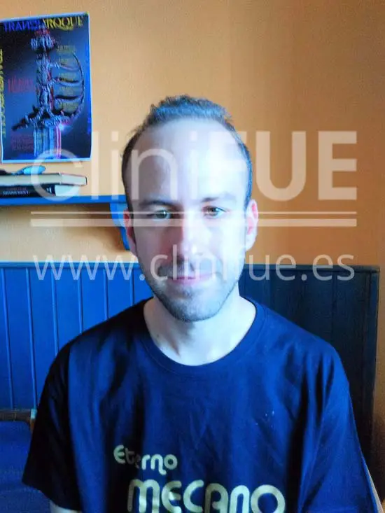Alberto 31 años Madrid trasplante capilar turquia Antes
