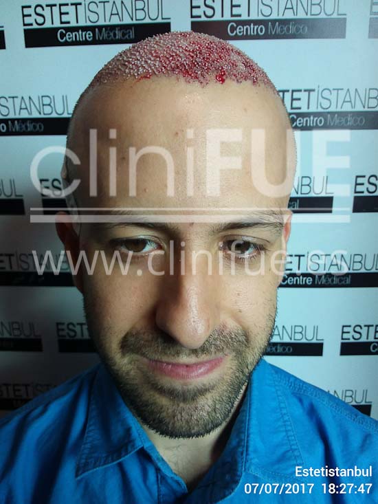Alberto 31 años Madrid trasplante capilar turquia Dia Operacion