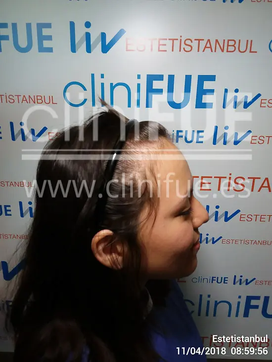 Diandra 22 Barcelona trasplante capilar femenino Antes