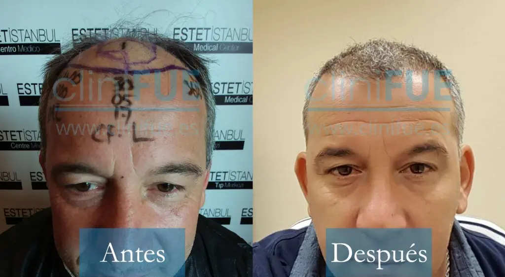 Fernando 46 Malaga 3500 UF trasplante capilar