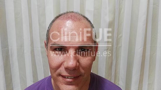 Jorge Aurelio 39 Murcia trasplante capilar turquia 1 mes