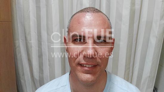Jorge Aurelio 39 Murcia trasplante capilar turquia 7 dias