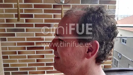 Jorge Aurelio 39 Murcia trasplante capilar turquia Antes
