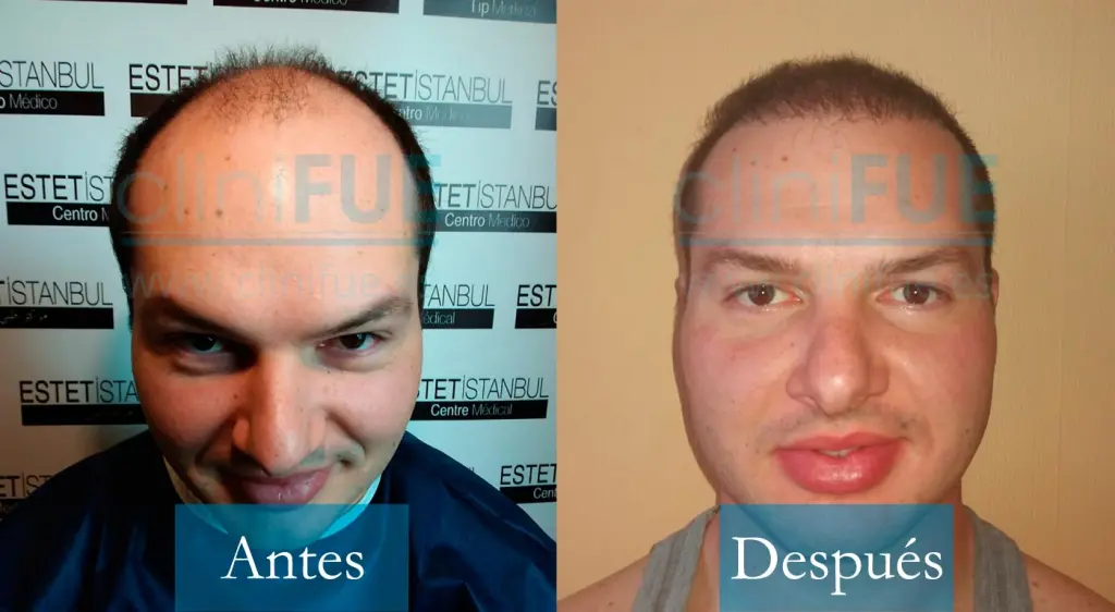 José - 30 años - Granada 4000UF trasplante de pelo