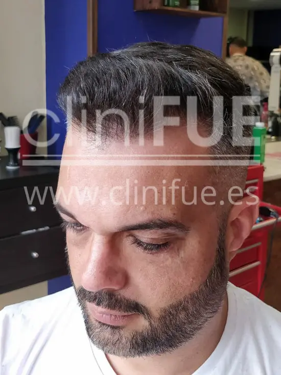 Roberto 40 Gran Canaria trasplante capilar turquia 7 meses
