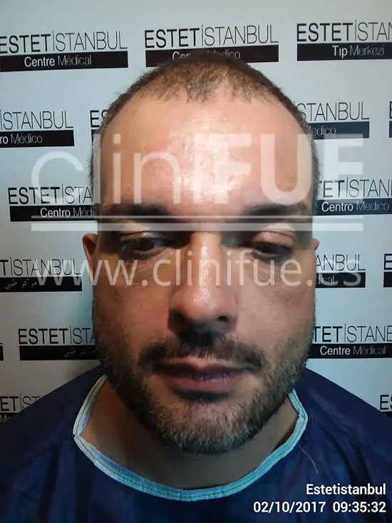 Roberto 40 Gran Canaria trasplante capilar turquia Antes