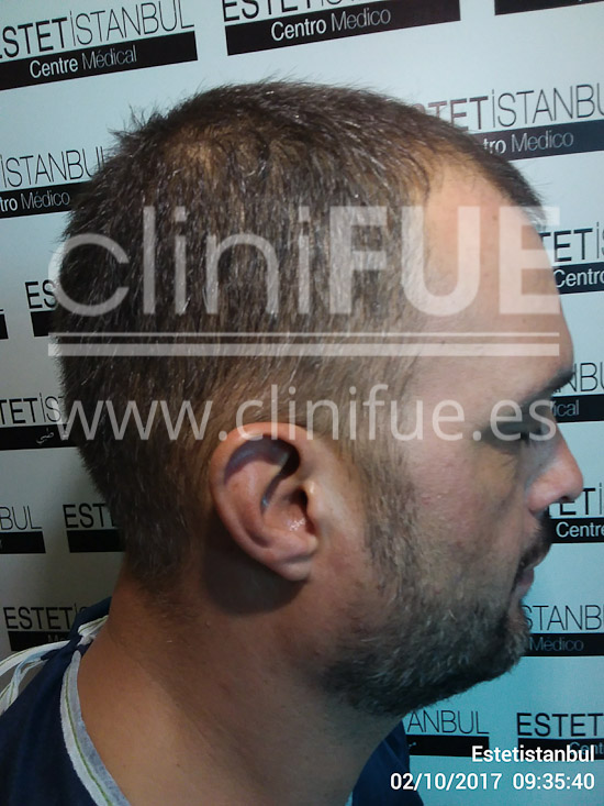 Roberto 40 Gran Canaria trasplante capilar turquia Antes