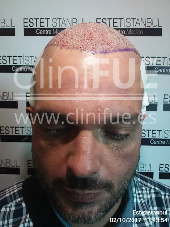 Roberto 40 Gran Canaria trasplante capilar turquia Dia Operacion