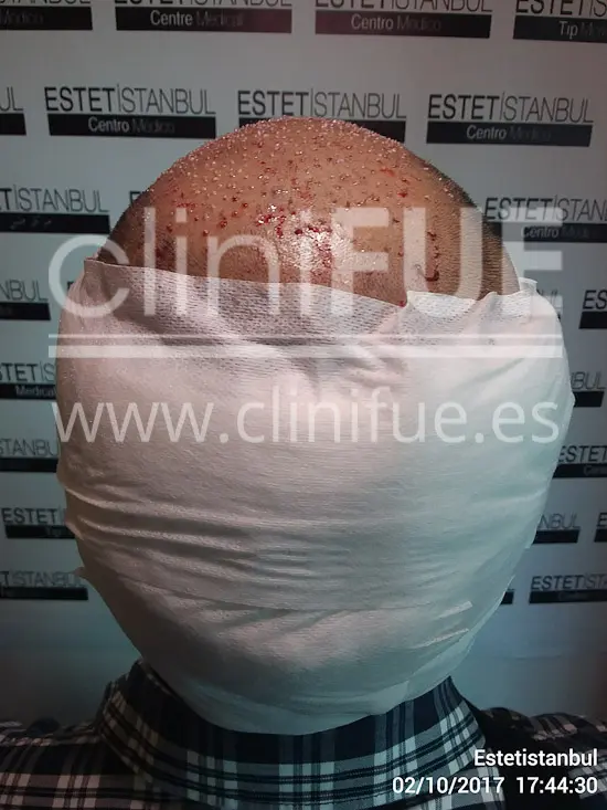 Roberto 40 Gran Canaria trasplante capilar turquia Dia Operacion