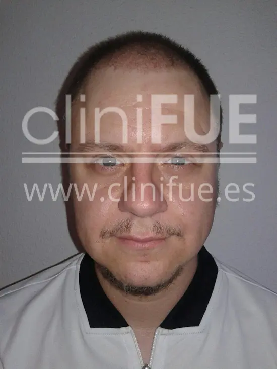 Rudy 37 Teruel trasplante capilar turquia 1 mes
