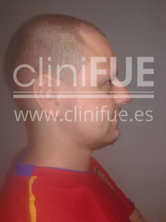 Rudy 37 Teruel trasplante capilar turquia 15 dias