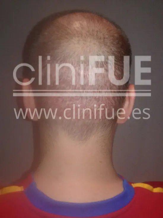 Rudy 37 Teruel trasplante capilar turquia 15 dias
