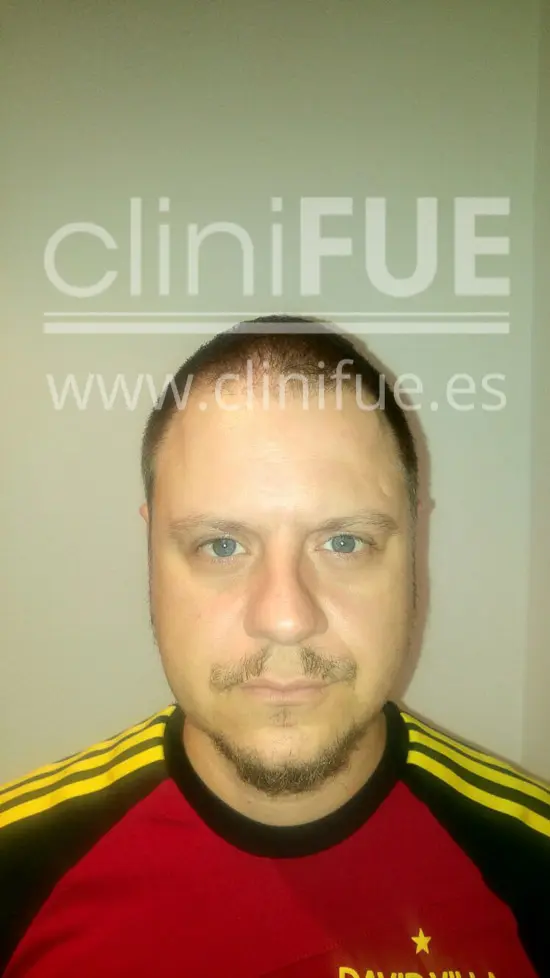 Rudy 37 Teruel trasplante capilar turquia 3 meses