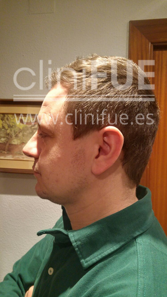 Rudy 37 Teruel trasplante capilar turquia 6 meses