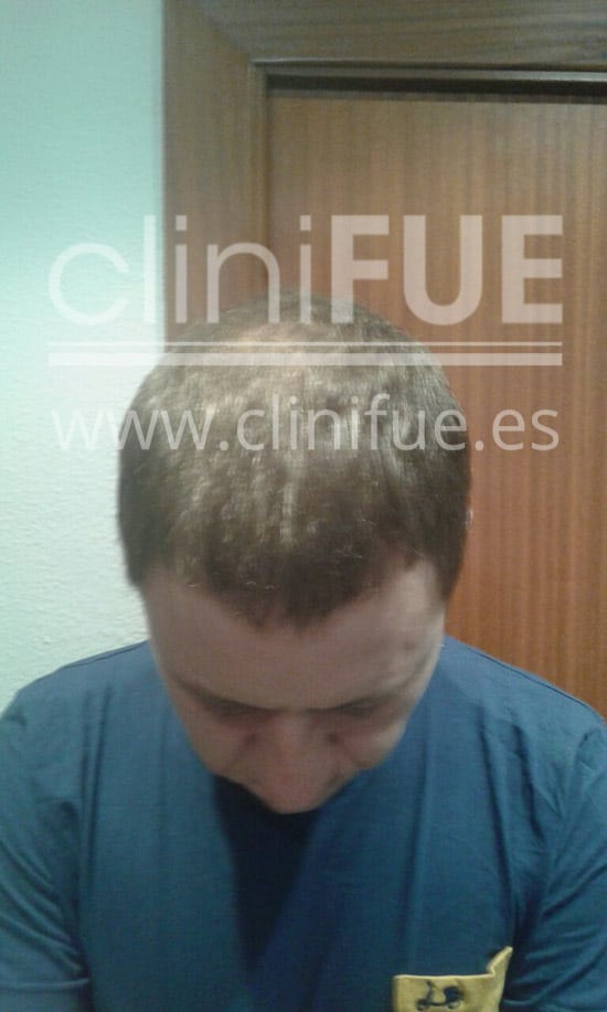 Rudy 37 Teruel trasplante capilar turquia 9 meses