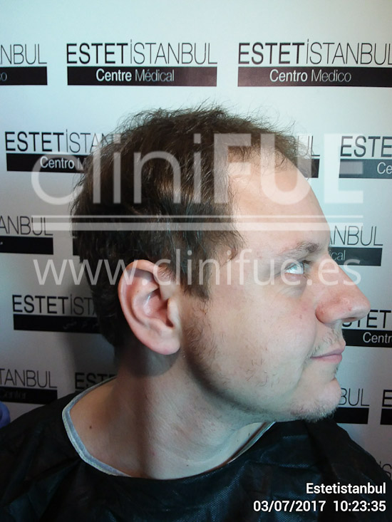 Rudy 37 Teruel trasplante capilar turquia Antes