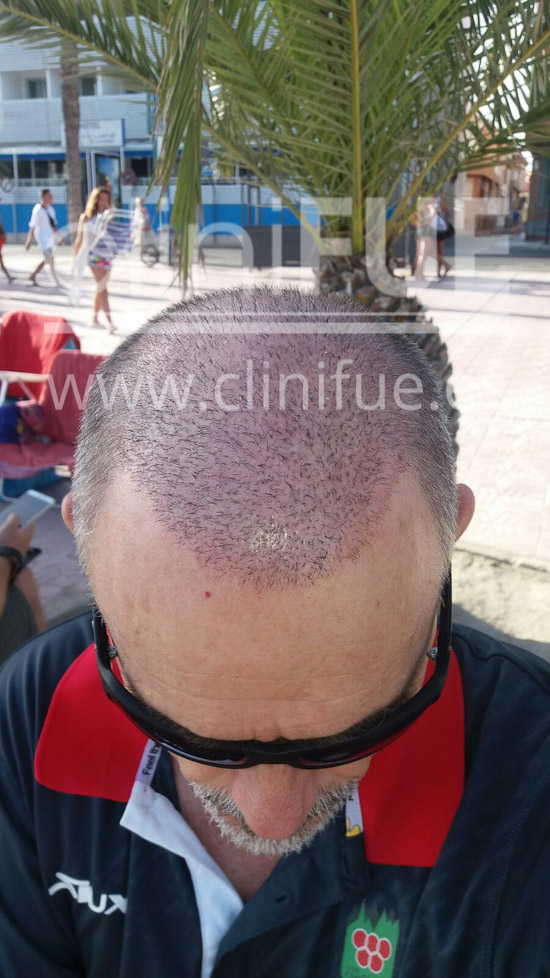 Tony 48 años Murcia injerto capilar turquia 15 dias