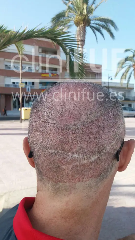Tony 48 años Murcia injerto capilar turquia 15 dias