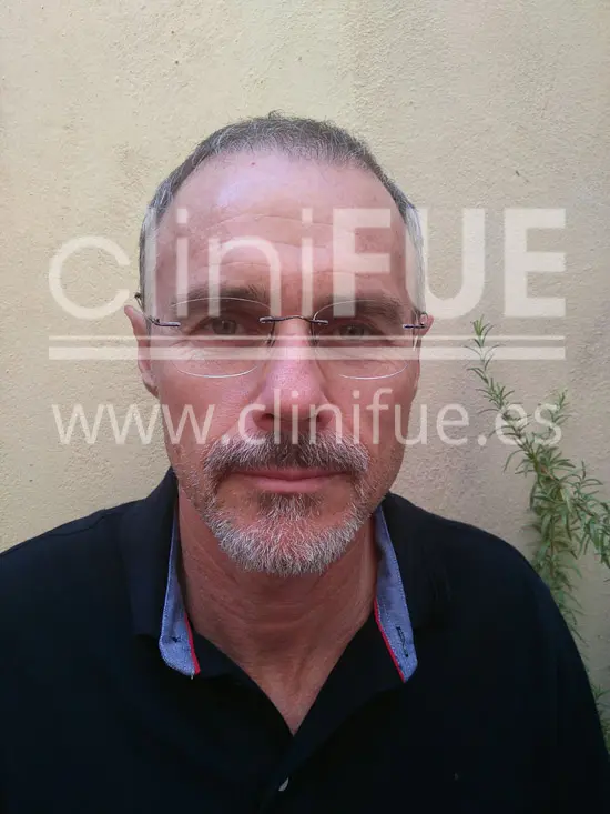 Tony 48 años Murcia injerto capilar turquia 3 meses