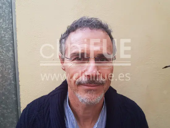 Tony 48 años Murcia injerto capilar turquia 6 meses