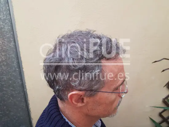 Tony 48 años Murcia injerto capilar turquia 6 meses