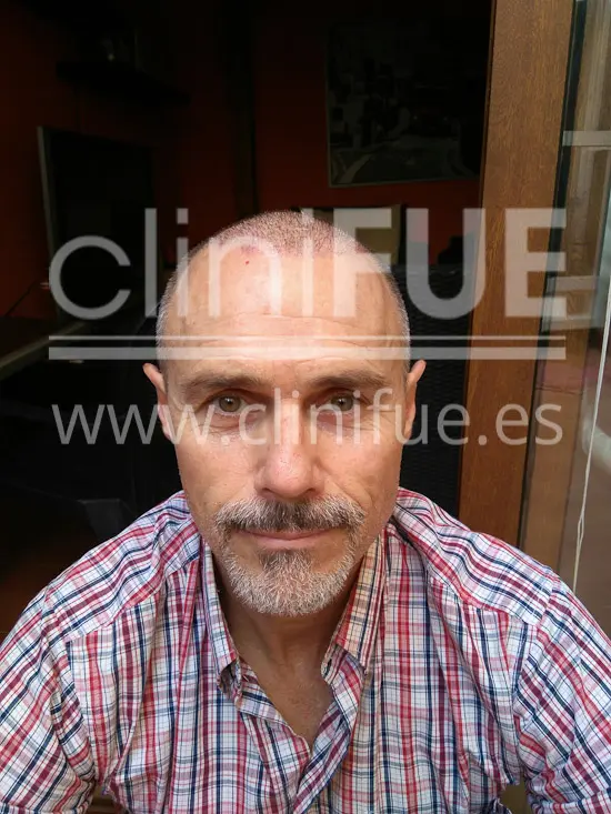 Tony 48 años Murcia injerto capilar turquia 7 dias