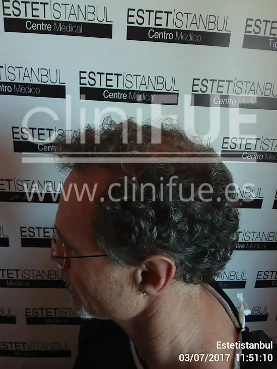 Tony 48 años Murcia injerto capilar turquia Antes