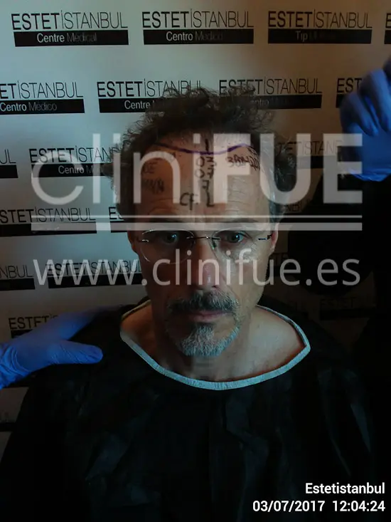 Tony 48 años Murcia injerto capilar turquia Dia Operacion