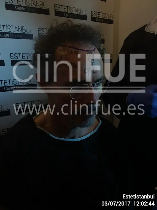 Tony 48 años Murcia injerto capilar turquia Dia Operacion