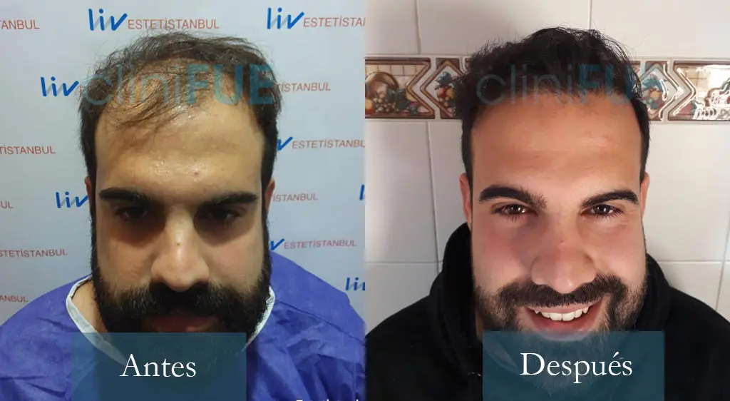 Sergio - 26 años - Alicante 4000UF trasplante de pelo