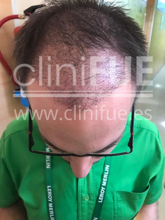 Carlos 30 años Madrid trasplante capilar turquia 4 meses