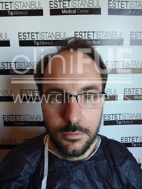 Carlos 30 años Madrid trasplante capilar turquia Antes