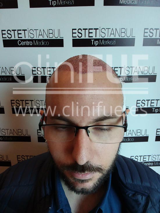 Carlos 30 años Madrid trasplante capilar turquia Dia Operacion